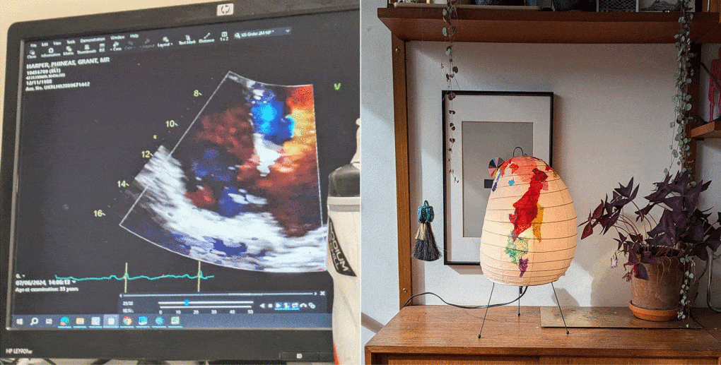 Left: Cardiogram of the a author's heart, after they were diagnosed with a hole in the heart called a patent formane ovale, or PFO. Right: The author's Akari lamp, after repair.
